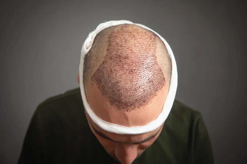 Hair Restoration