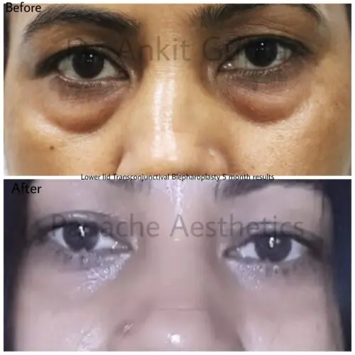 Blepharoplasty before and after result — Dr. Ankit Gupta, Panache Aesthetics Delhi