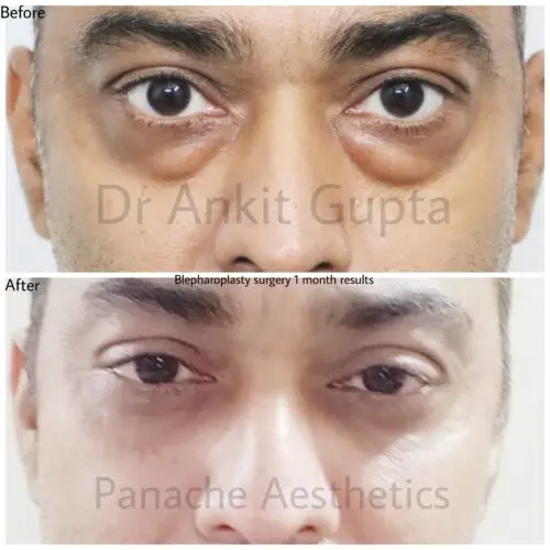 Upper and lower blepharoplasty result — Dr. Ankit Gupta Delhi