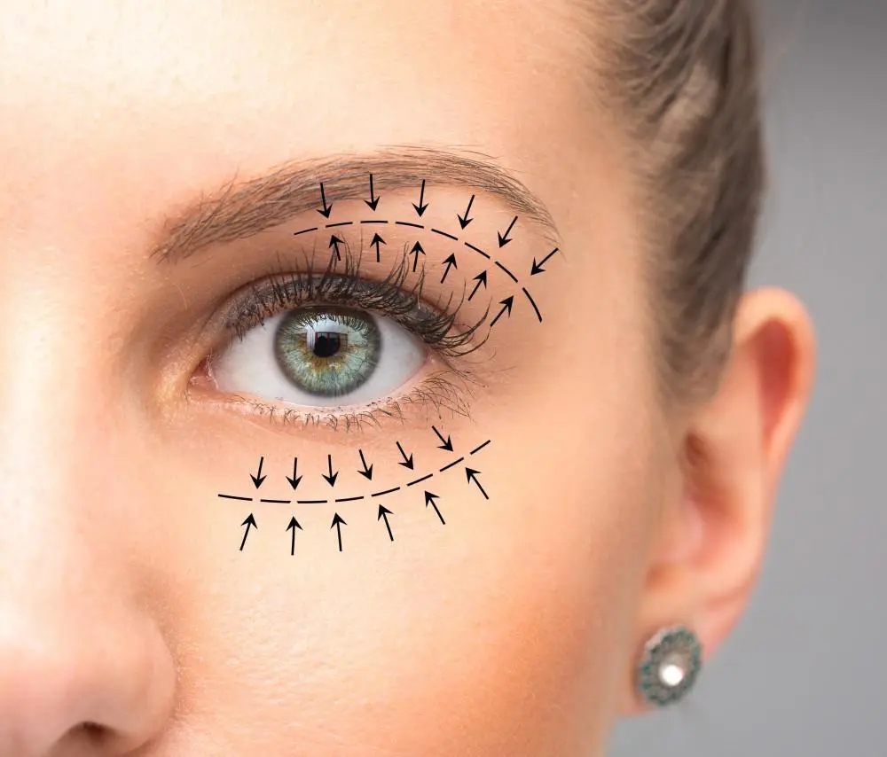 Eyelid surgery before after result Delhi — Panache Aesthetics
