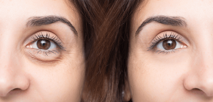 Four-lid blepharoplasty before after Panache Aesthetics Delhi