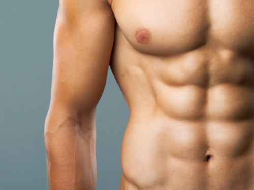 Gynecomastia gland excision before after result — Dr. Ankit Gupta Delhi