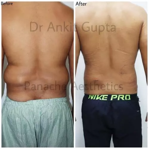 Liposuction back and flanks before and after result — Dr. Ankit Gupta, Panache Aesthetics Delhi