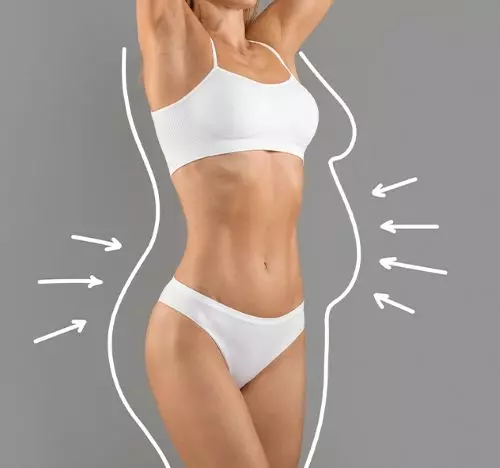 Mommy makeover result — abdominal contouring — Panache Aesthetics