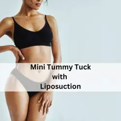 Full abdominoplasty before after — Panache Aesthetics Pitampura Delhi