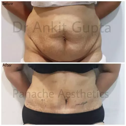 Tummy tuck before and after result — Dr. Ankit Gupta, Panache Aesthetics Delhi