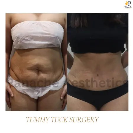Abdominoplasty with muscle repair before and after result — Delhi