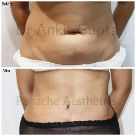 Diastasis recti correction before and after — flat firm abdomen — Dr. Ankit Gupta