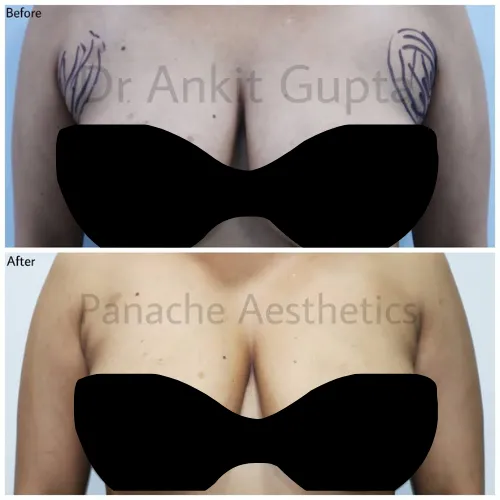 Accessory breast removal in Delhi before and after — front view — Panache Aesthetics
