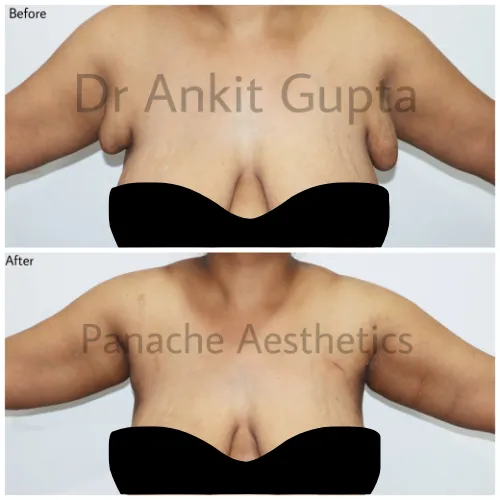 Accessory breast removal in Delhi before and after — Dr. Ankit Gupta, Panache Aesthetics