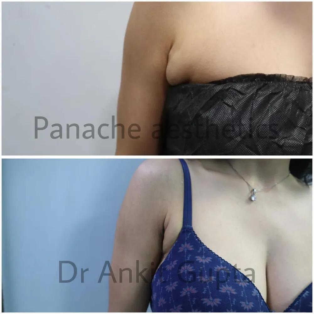 Armpit fat removal surgery in Delhi — side view before and after — Panache Aesthetics