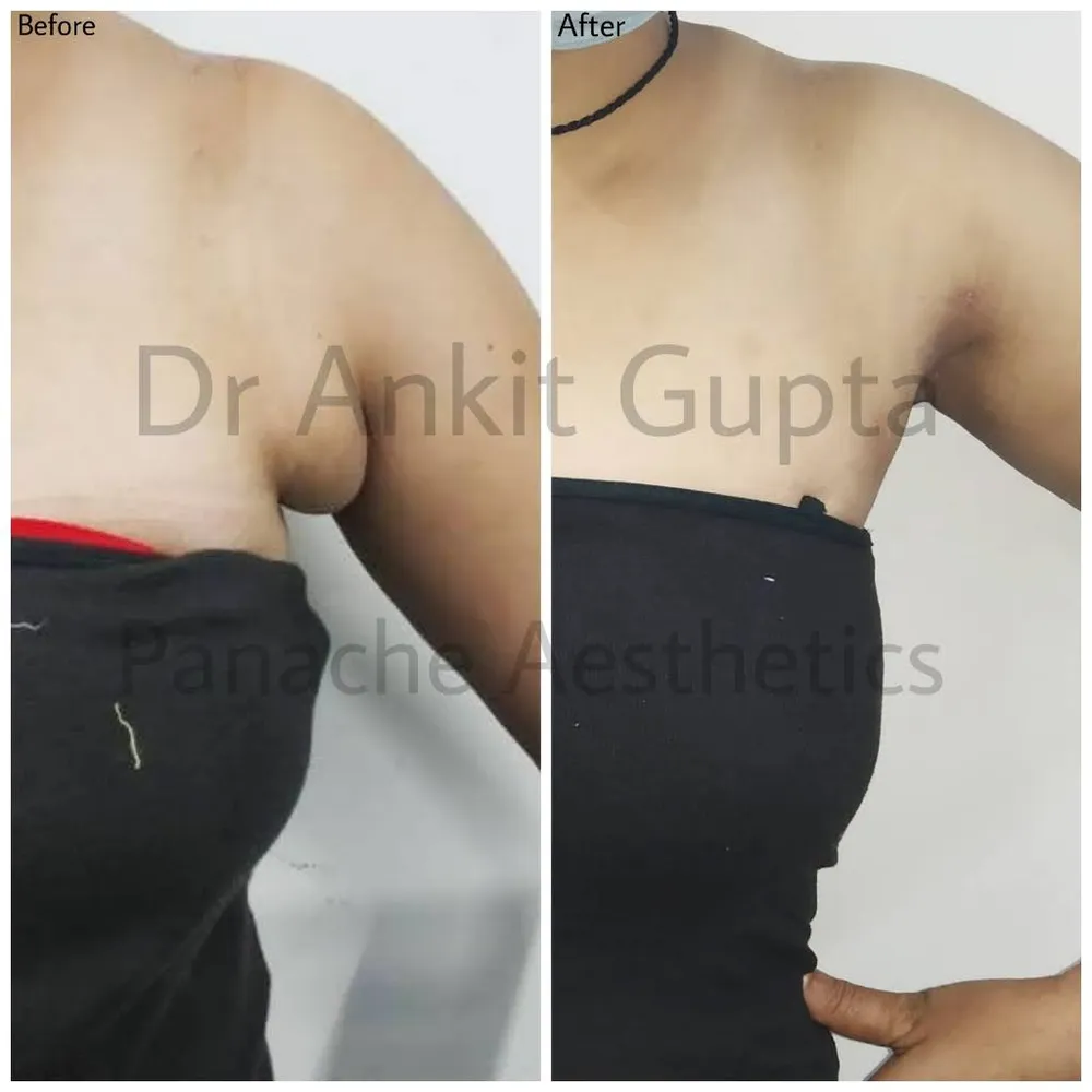 Armpit fat removal surgery in Delhi — side-profile before and after — Panache Aesthetics