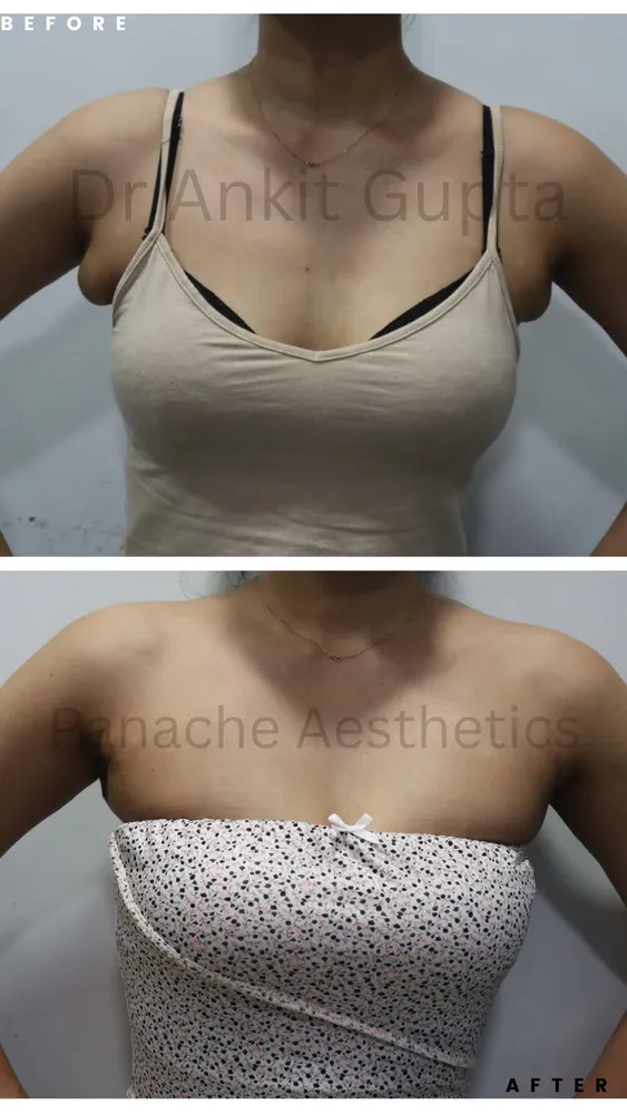 Axillary breast removal in Delhi before and after — front view — Panache Aesthetics