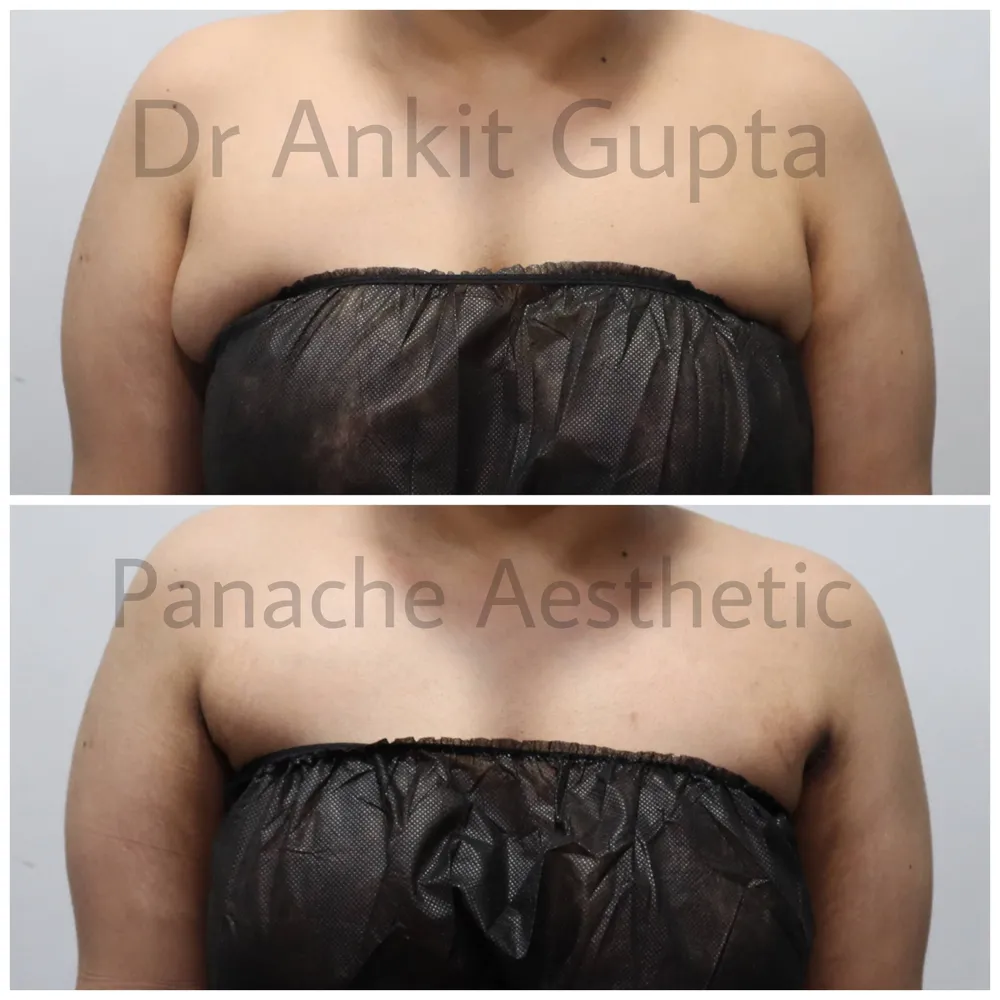 Axillary breast surgery in Delhi before and after — front view — Dr. Ankit Gupta