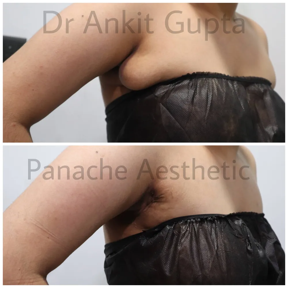 Axillary breast surgery in Delhi — side-view before and after — Panache Aesthetics