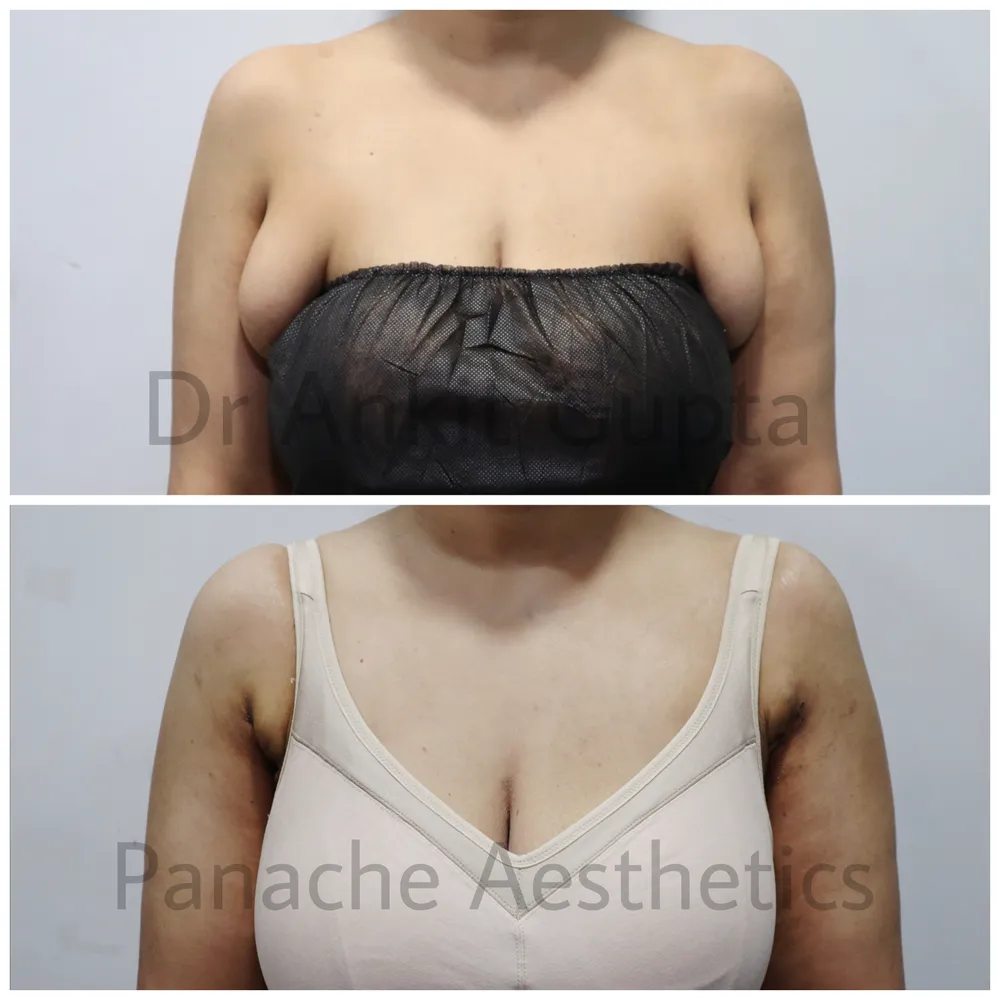 Axillary fat pad removal in Delhi before and after — front view in compression garment — Dr. Ankit Gupta