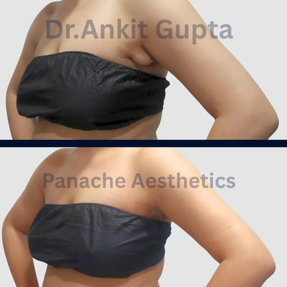 Axillary fat removal in Delhi — side-view before and after — Dr. Ankit Gupta, Panache Aesthetics