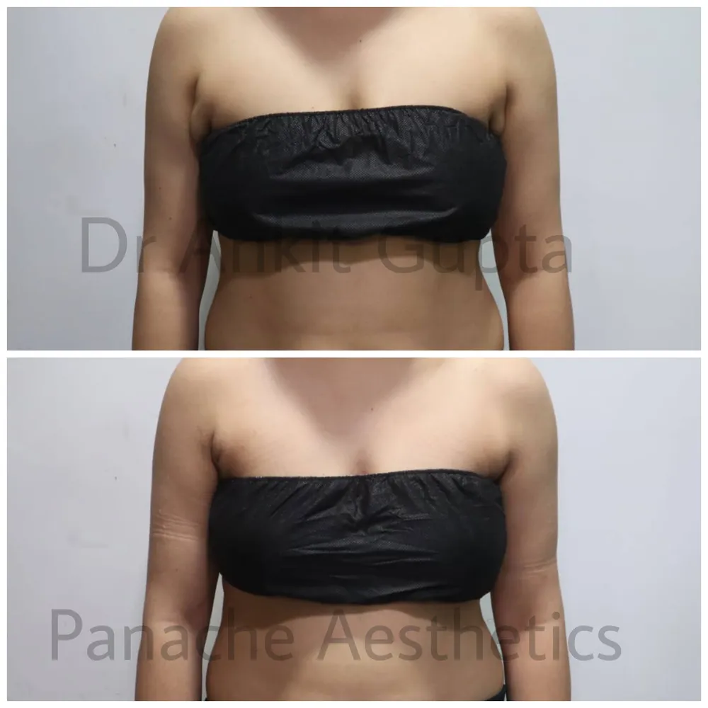Axillary fat removal in Delhi before and after — front bandeau view of underarm contour — Panache Aesthetics