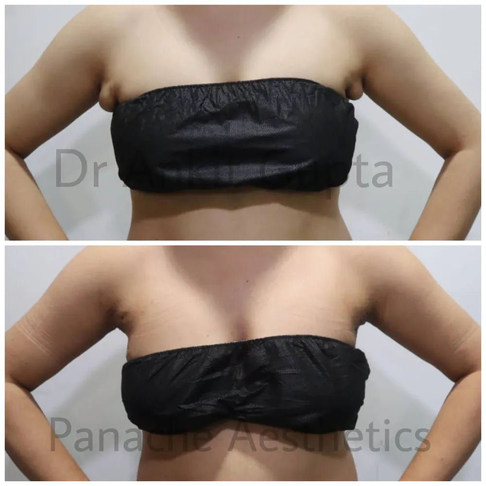 Axillary fat removal in Delhi before and after — front bandeau view — Panache Aesthetics