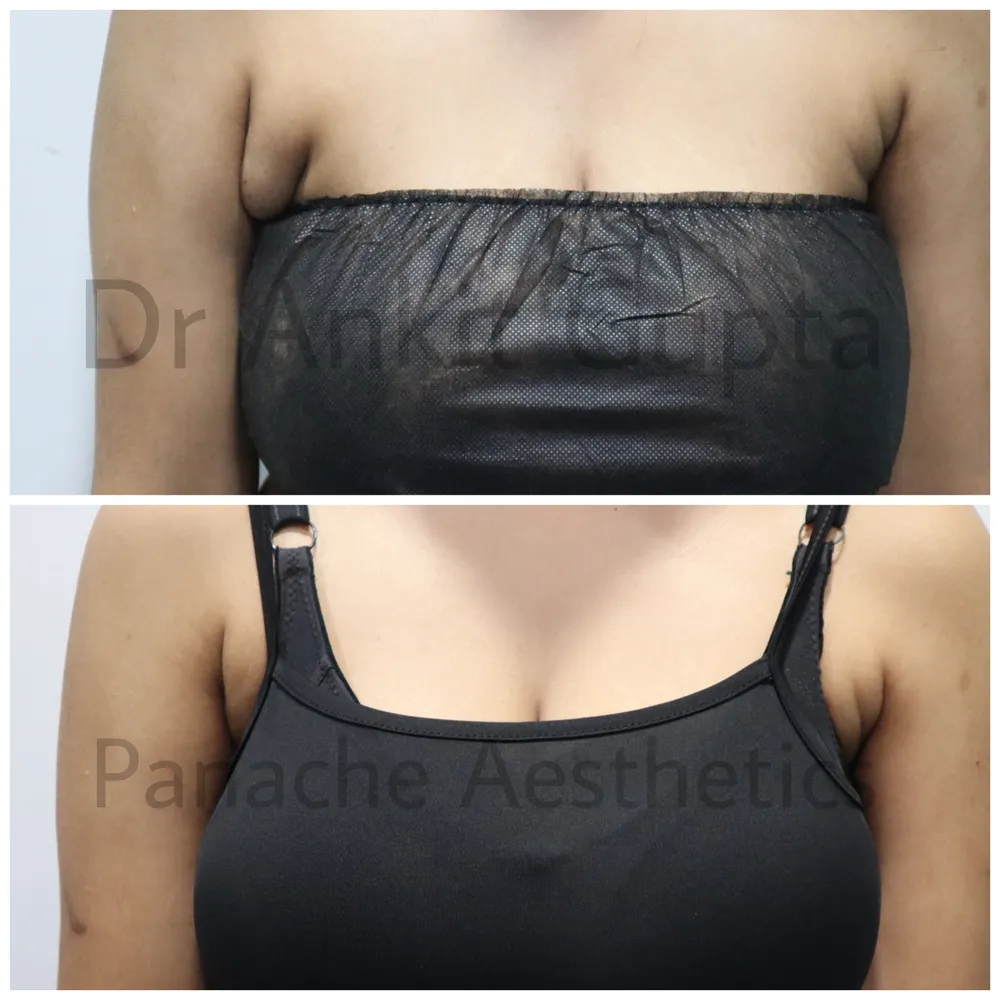 Underarm breast tissue removal in Delhi before and after — front view — Dr. Ankit Gupta, Panache Aesthetics