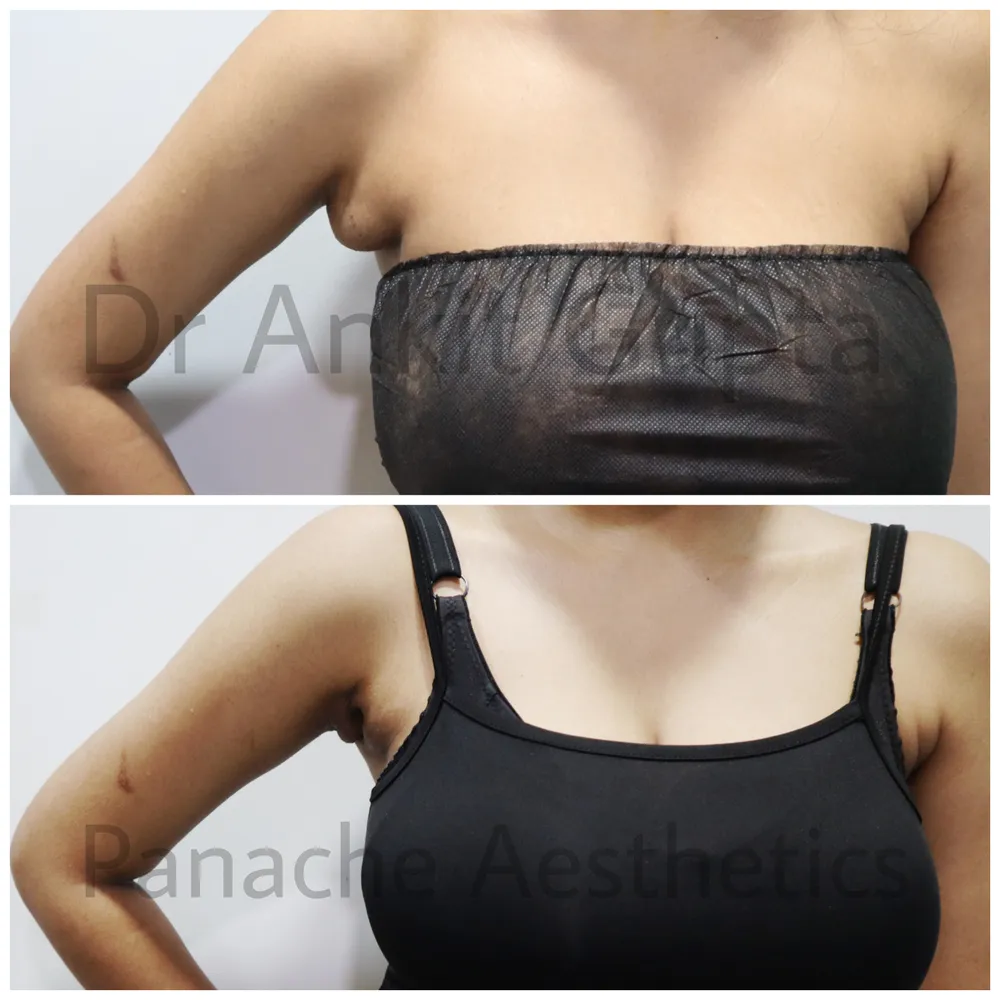 Underarm breast tissue removal in Delhi before and after — oblique view — Panache Aesthetics