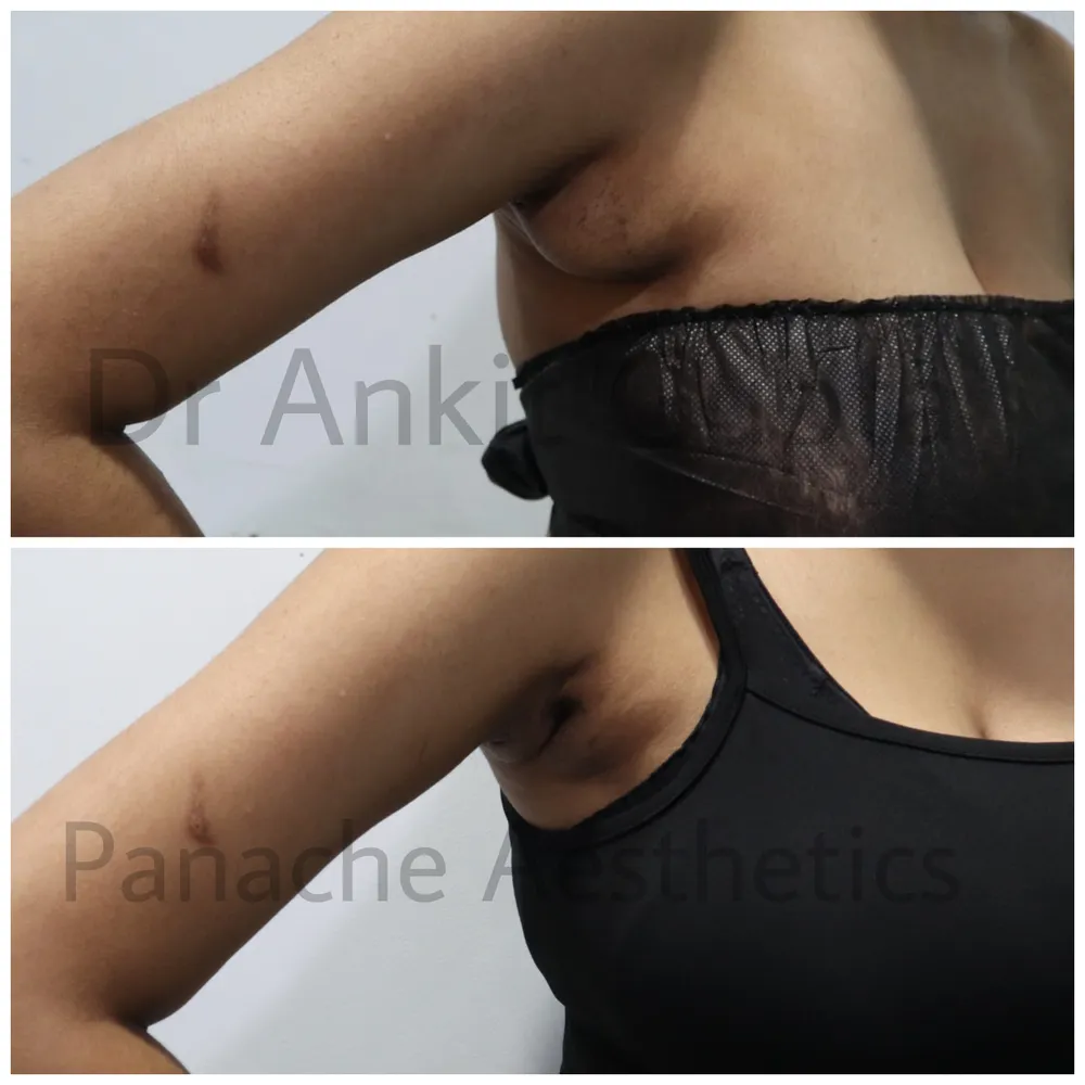Underarm bulge removal in Delhi before and after — close side view — Panache Aesthetics