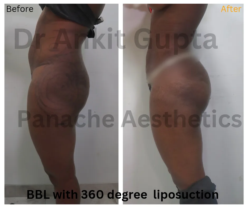Brazilian Butt Lift with 360° liposuction before and after — side profile showing buttock projection — Panache Aesthetics, Delhi