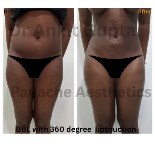 BBL with 360-degree liposuction before and after in Delhi — front view body contouring — Dr. Ankit Gupta