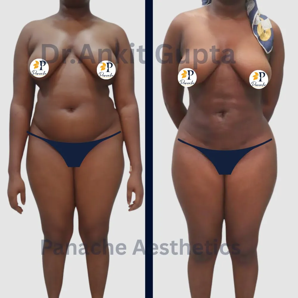 Brazilian Butt Lift result — Panache Aesthetics, Delhi