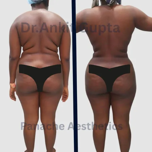 Brazilian Butt Lift before and after — rear view showing rounder, projected buttocks — Dr. Ankit Gupta, Panache Aesthetics Delhi