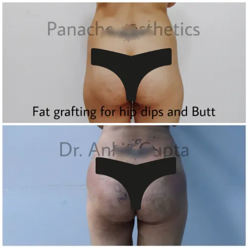 Fat grafting for hip dips and buttocks before and after — continuous hip curve — Panache Aesthetics, Delhi