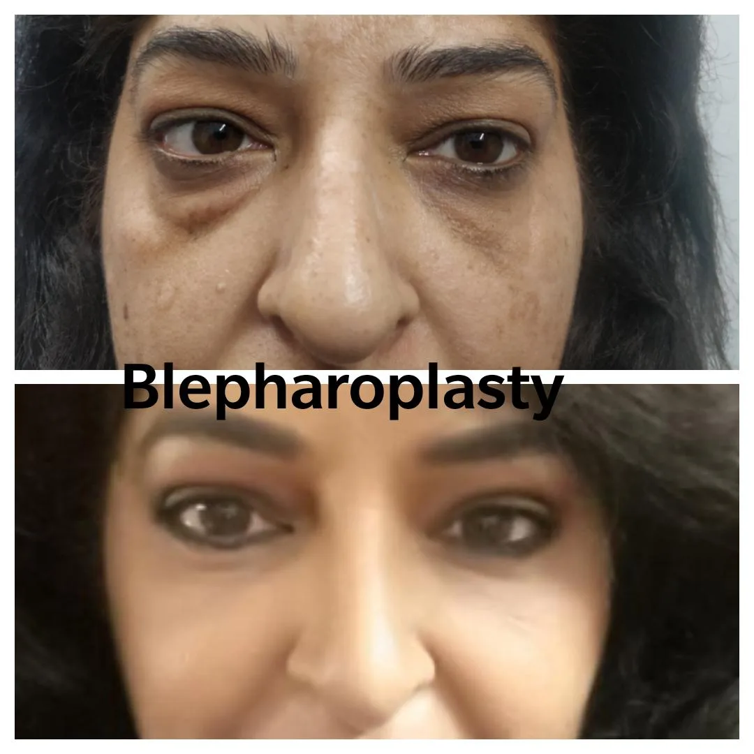 Blepharoplasty surgery in Delhi before and after — upper eyelid — Dr. Ankit Gupta, Panache Aesthetics