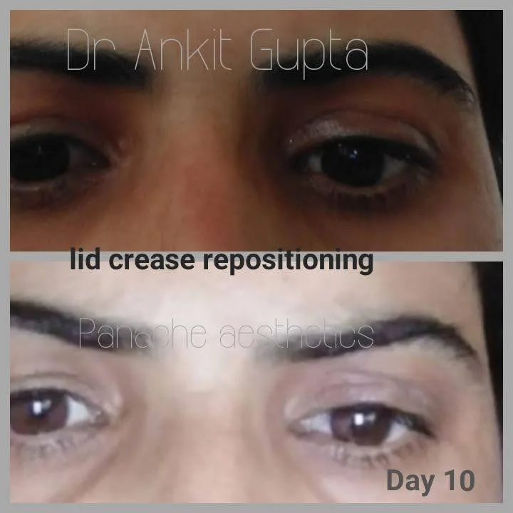 Lower eyelid surgery before and after — under-eye bag removal — Panache Aesthetics Delhi