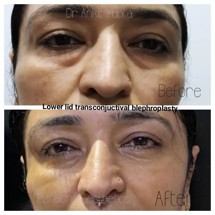 Four-lid blepharoplasty before and after result — complete eye rejuvenation — Dr. Ankit Gupta
