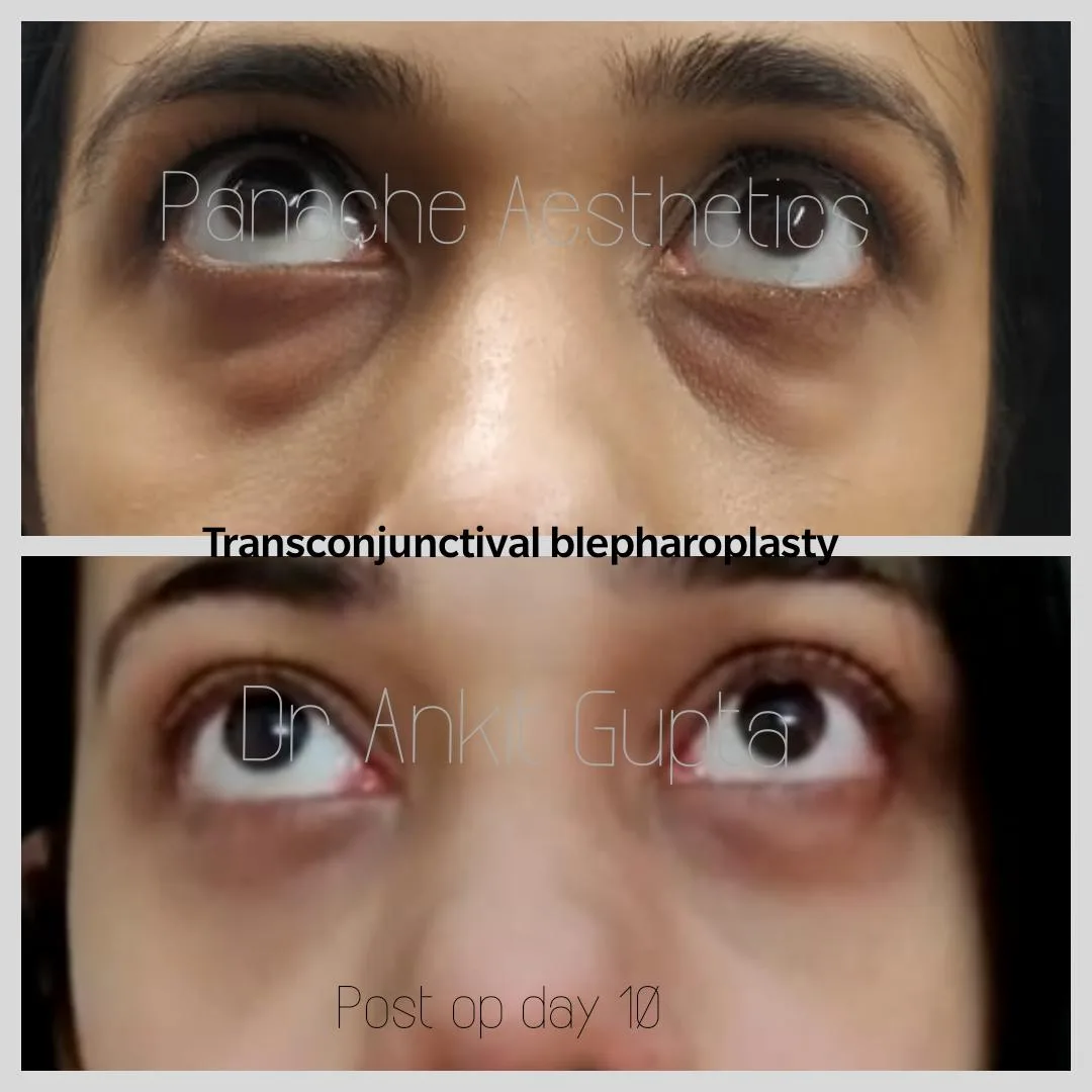 Blepharoplasty before and after result — upper eyelid surgery — Dr. Ankit Gupta, Panache Aesthetics Delhi