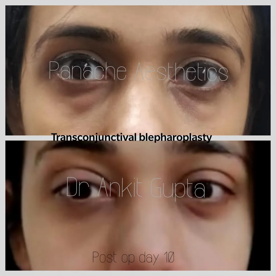 Eyelid surgery before and after — refreshed youthful eyes — Panache Aesthetics Delhi