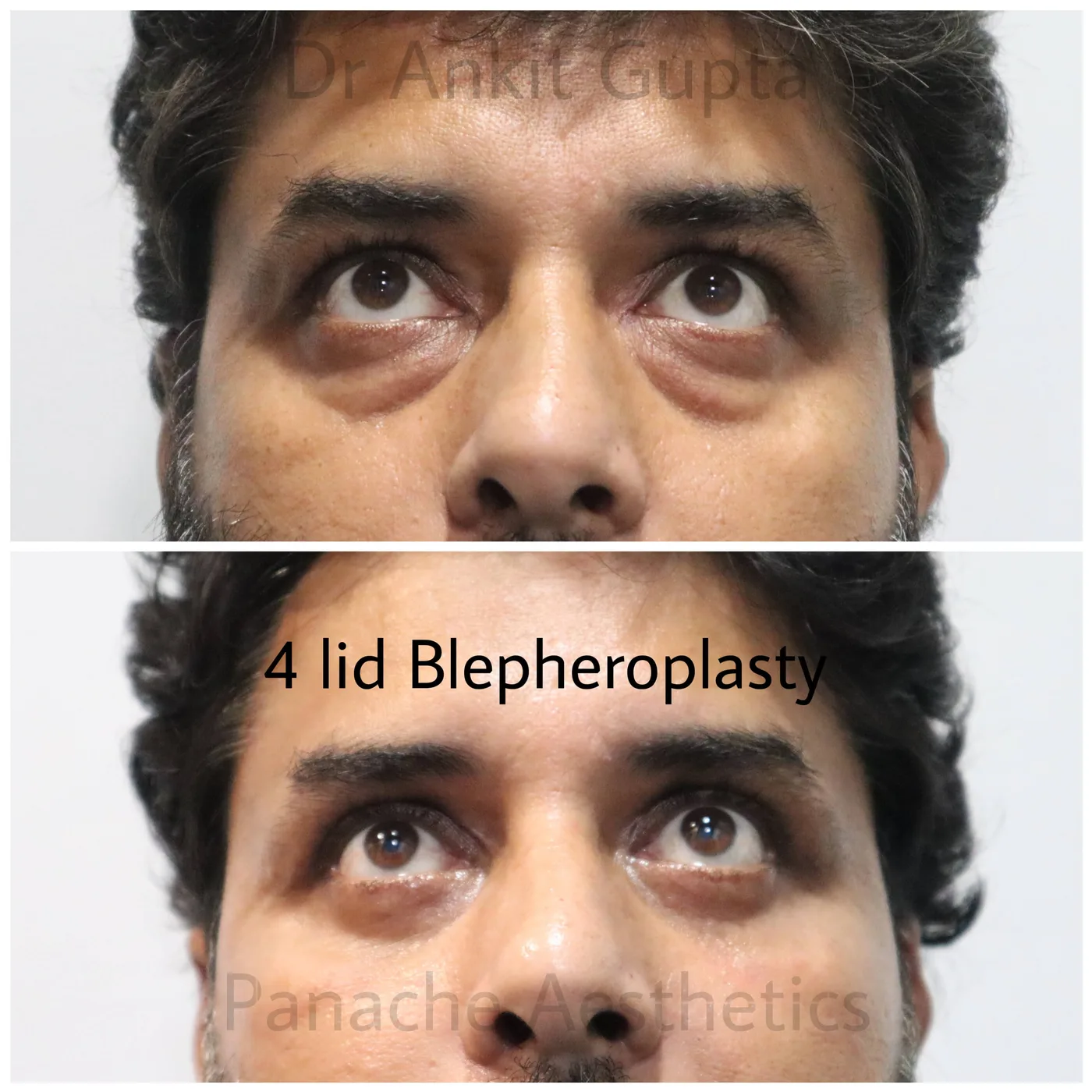 Lower eyelid blepharoplasty before and after — under-eye correction — Dr. Ankit Gupta