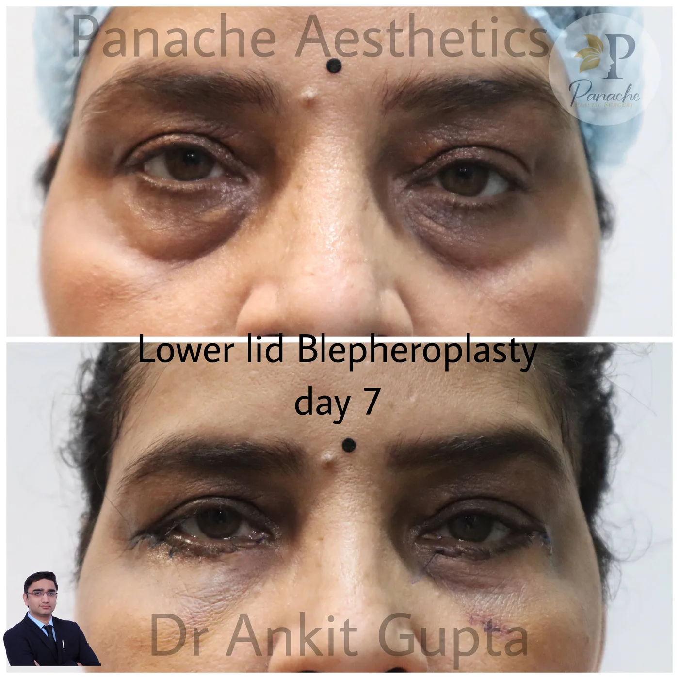 Upper eyelid blepharoplasty before and after — excess skin removal — Dr. Ankit Gupta, Panache Aesthetics Delhi