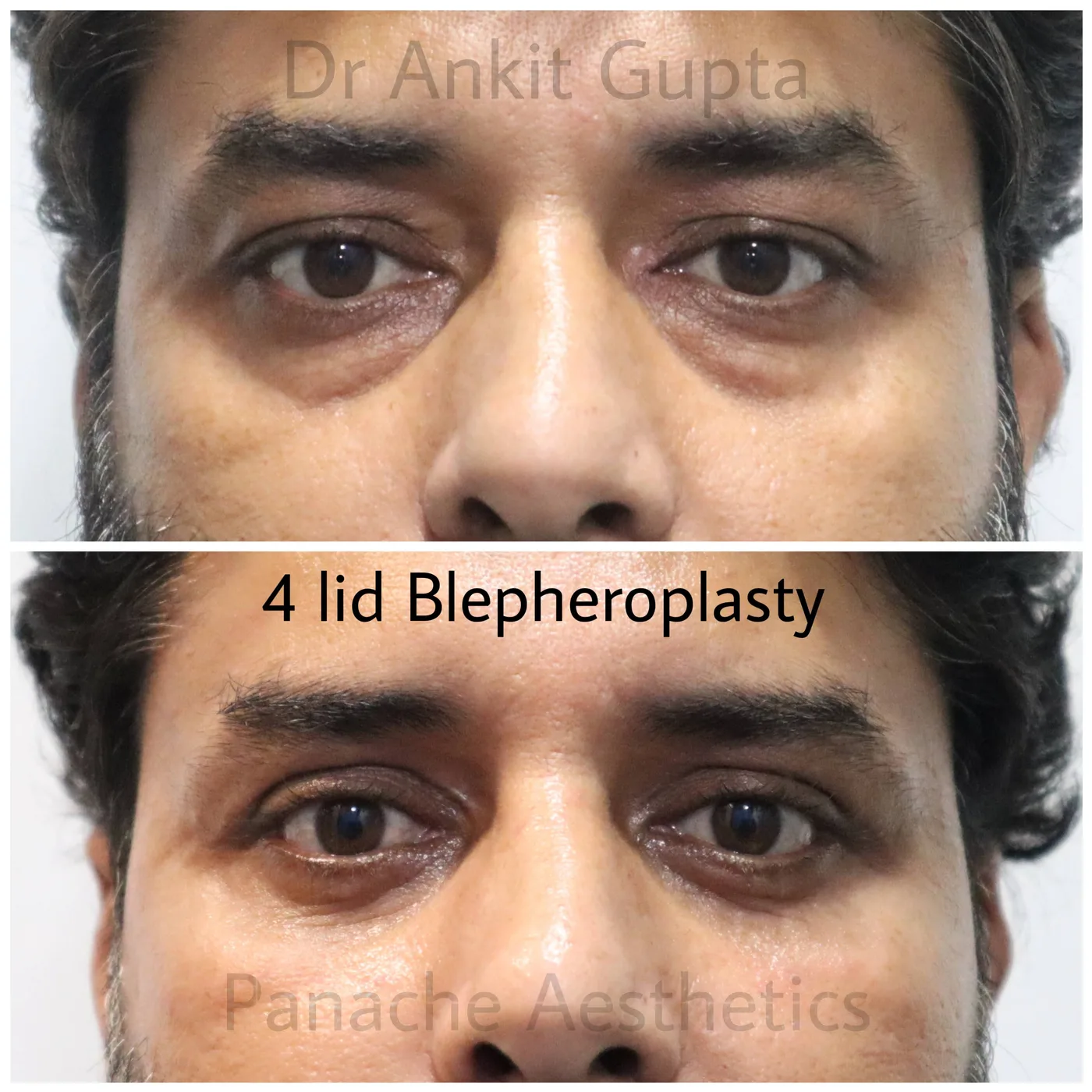 Droopy upper eyelid surgery before and after result — Panache Aesthetics Delhi