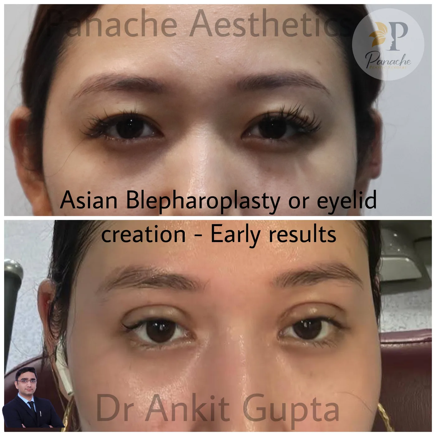Upper blepharoplasty before and after — heavy eyelid lift — Dr. Ankit Gupta