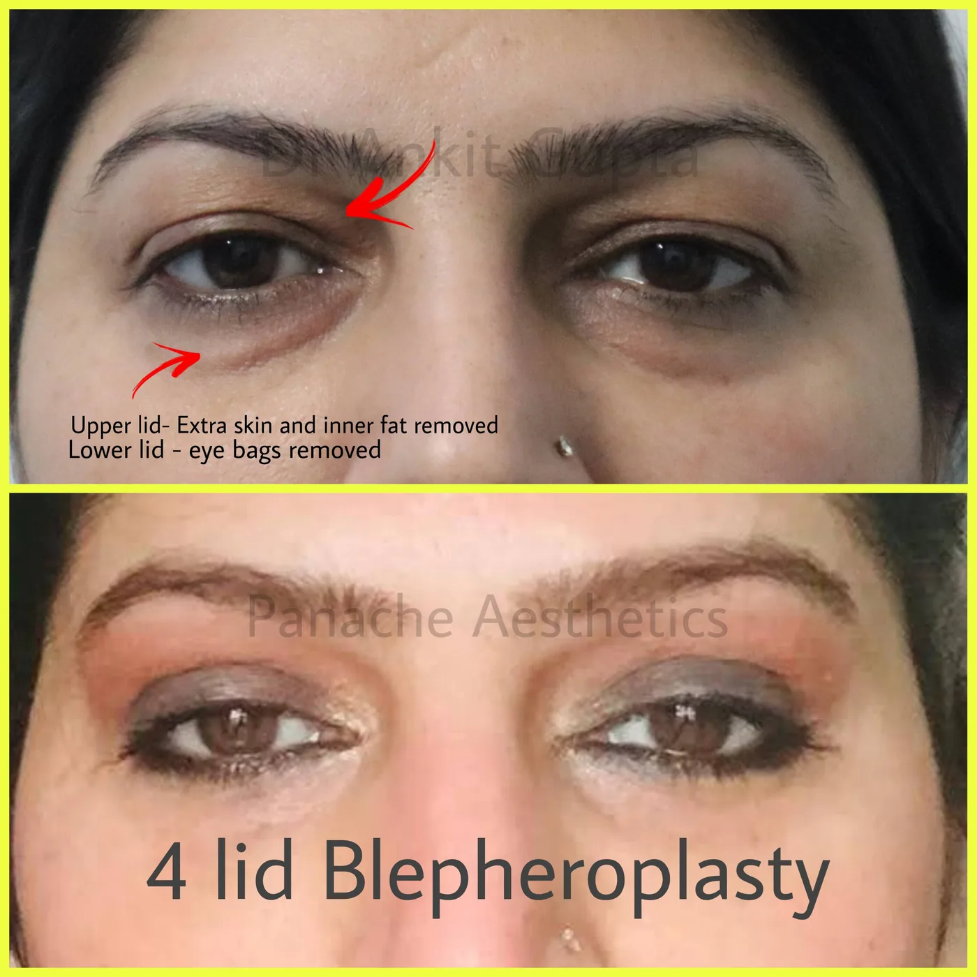 Eyelid specialist Delhi before and after — upper eyelid surgery — Dr. Ankit Gupta, Panache Aesthetics