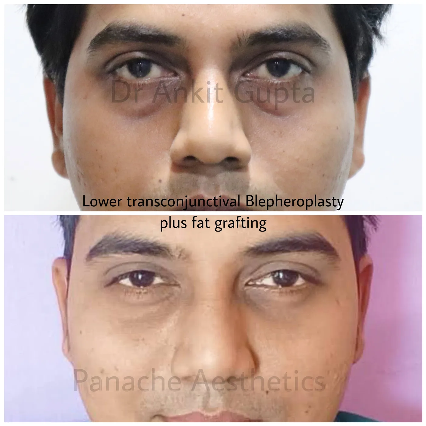 Lower eyelid surgery before and after — eye bag and dark circle correction — Delhi