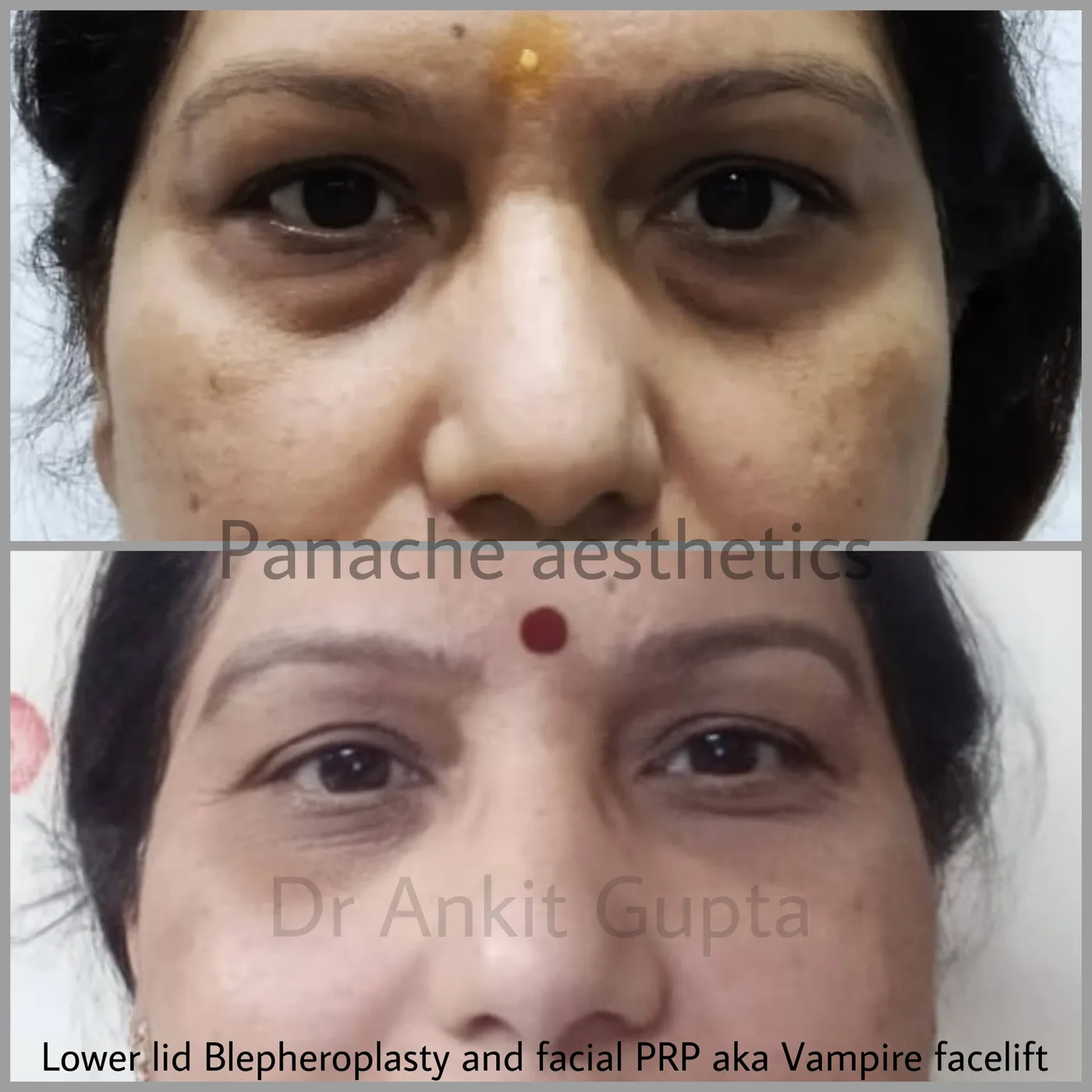 Complete eye rejuvenation before and after — four-lid blepharoplasty — Dr. Ankit Gupta