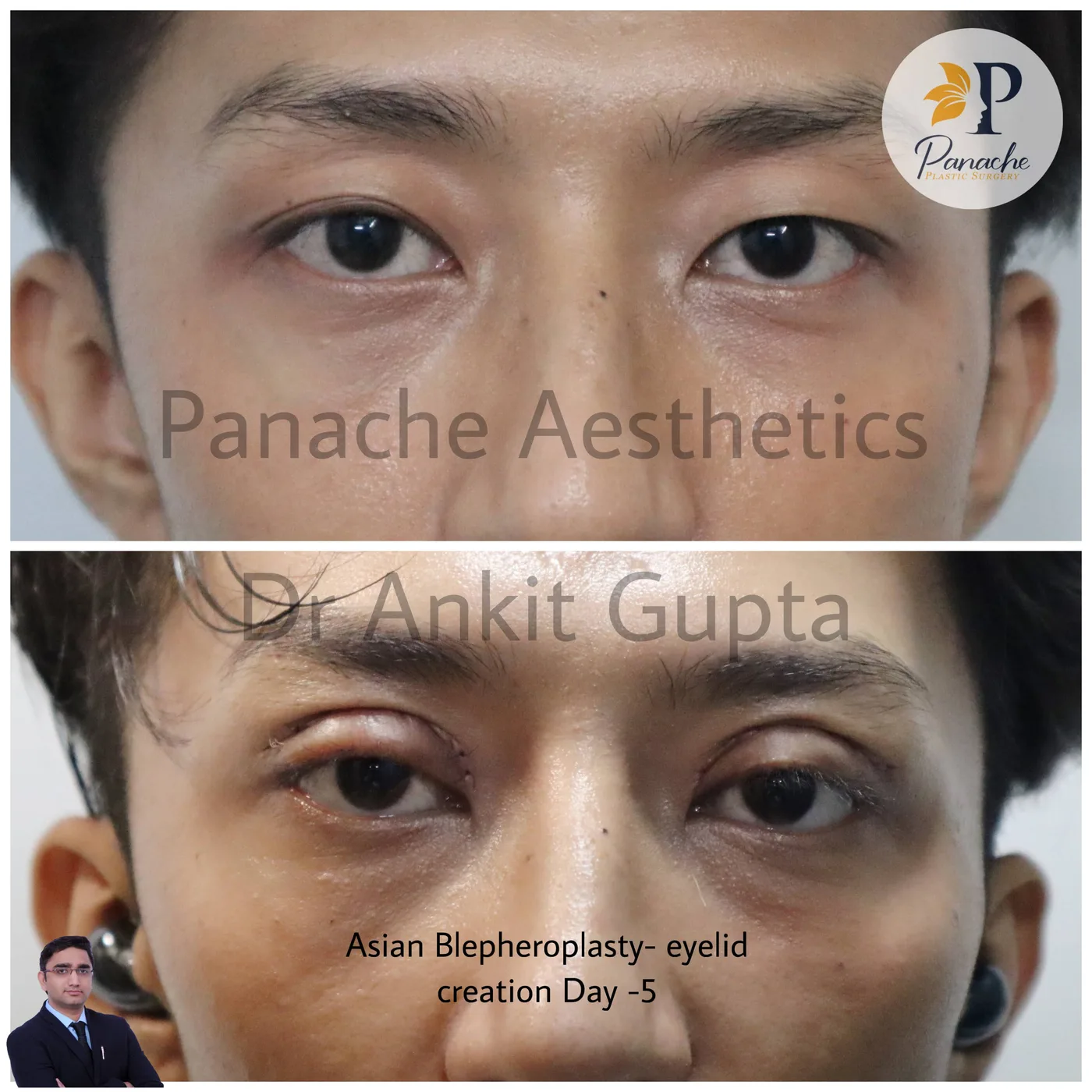 Four eyelid surgery before and after — upper and lower lid blepharoplasty — Dr. Ankit Gupta, Panache Aesthetics Delhi