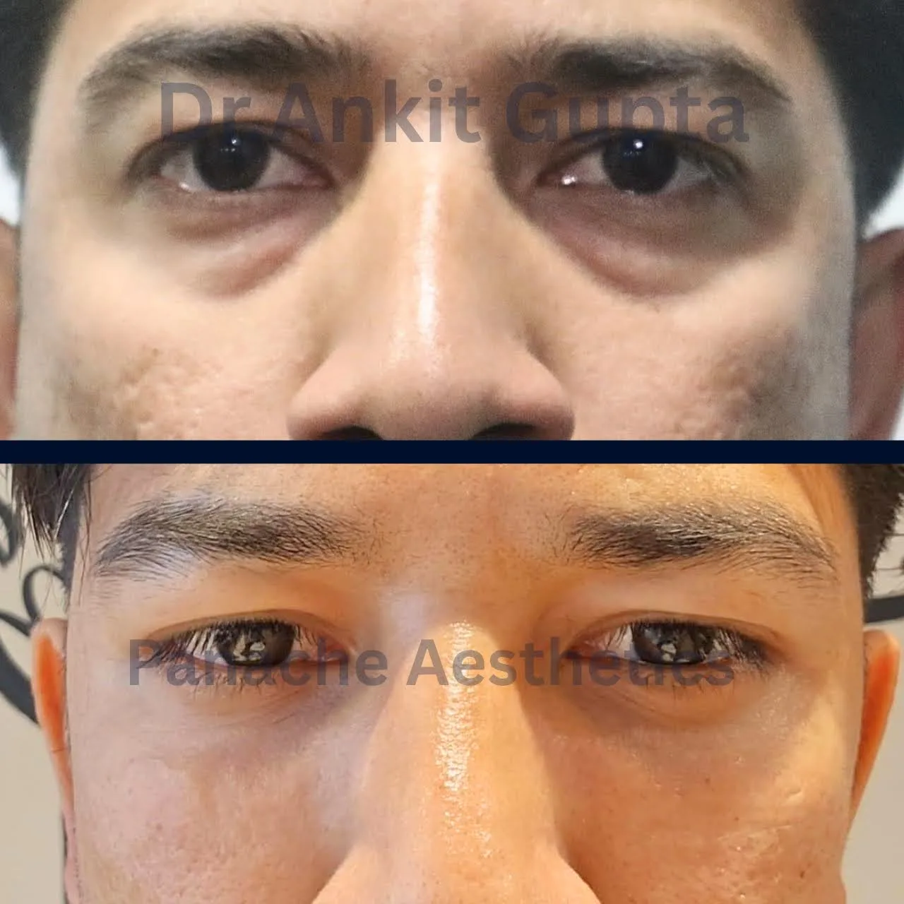 Quad blepharoplasty before and after — complete eye rejuvenation — Delhi