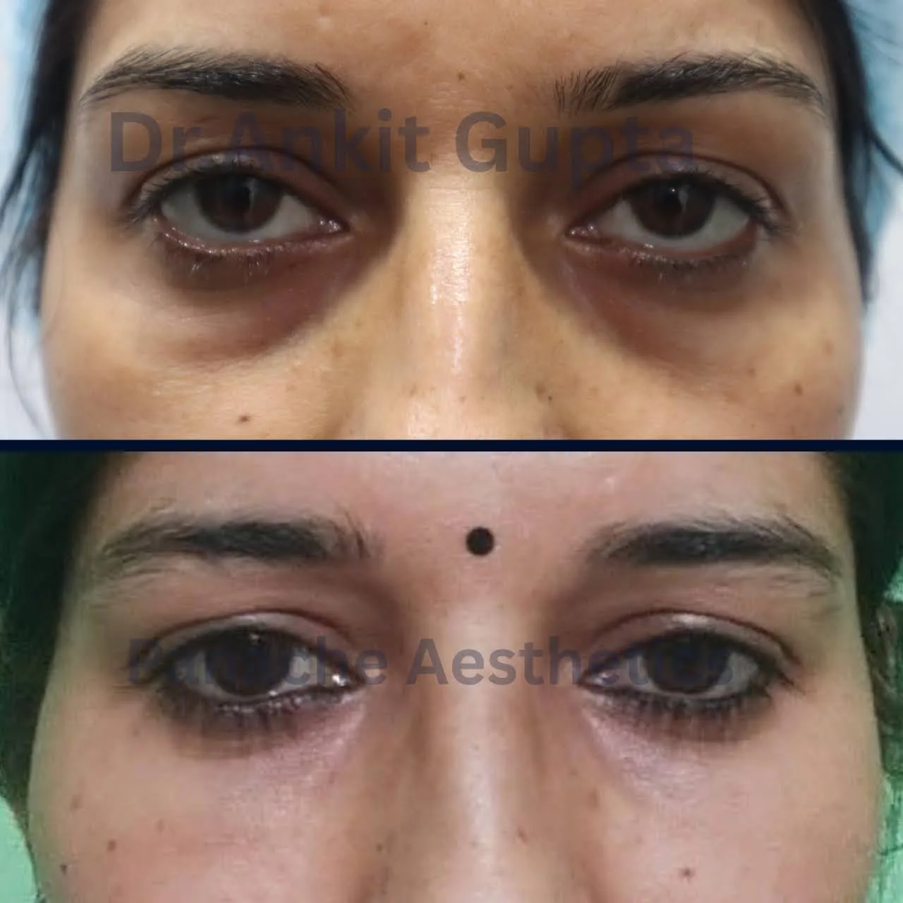 Four lid eyelid surgery result before and after — younger eye area — Dr. Ankit Gupta