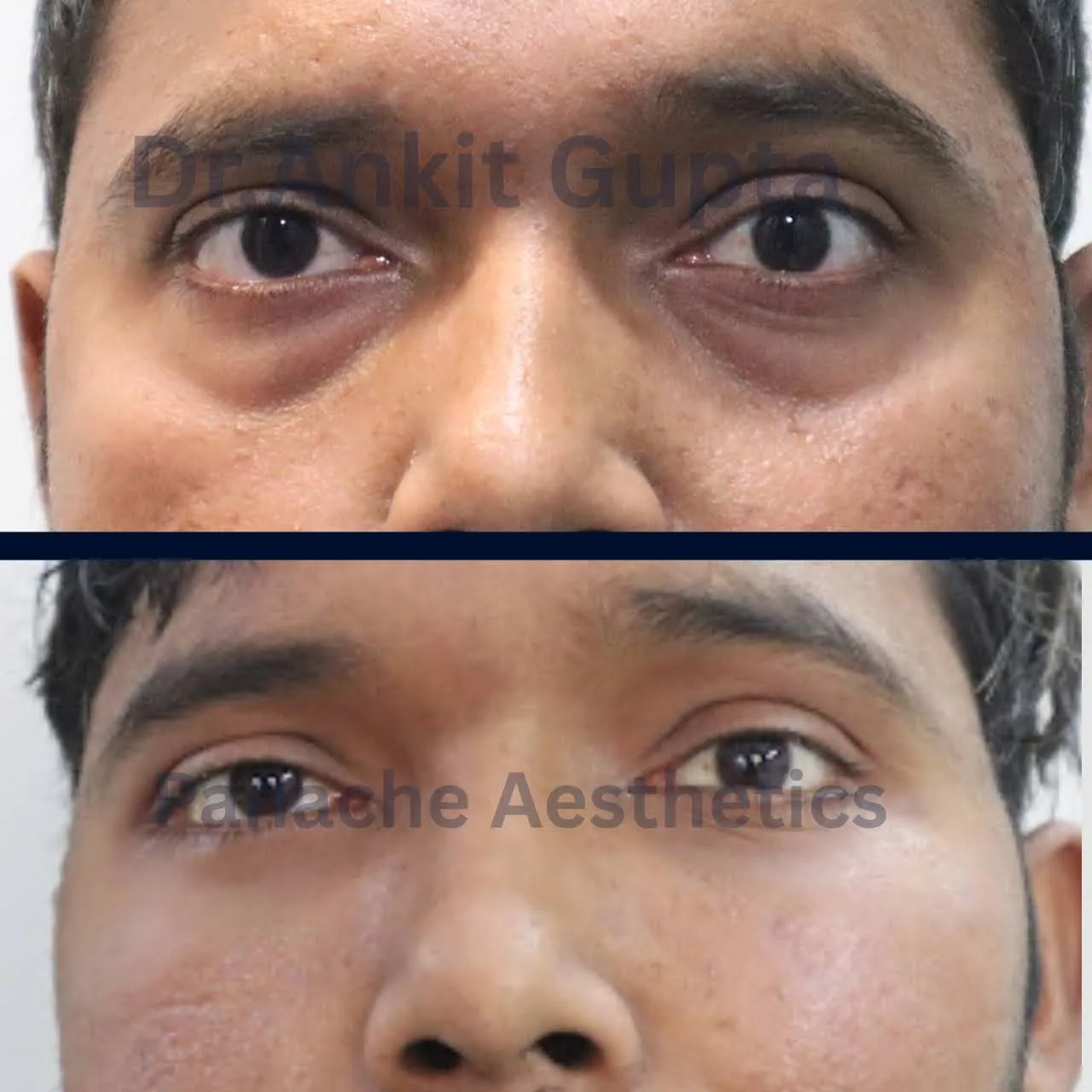 Blepharoplasty before and after — upper eyelid surgery — Dr. Ankit Gupta, Panache Aesthetics Delhi