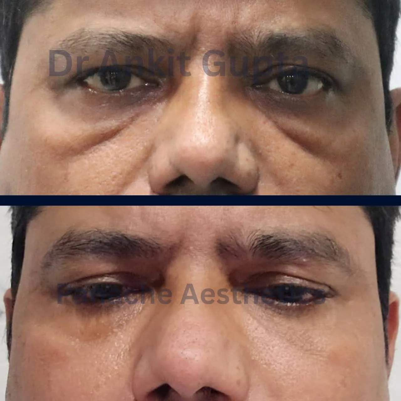 Eyelid surgery before and after — smooth recovery, natural result — Delhi