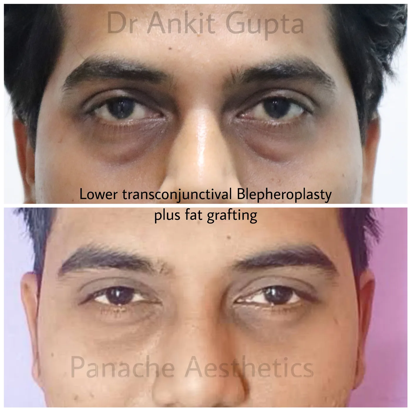 Lower eyelid blepharoplasty before and after result — Dr. Ankit Gupta