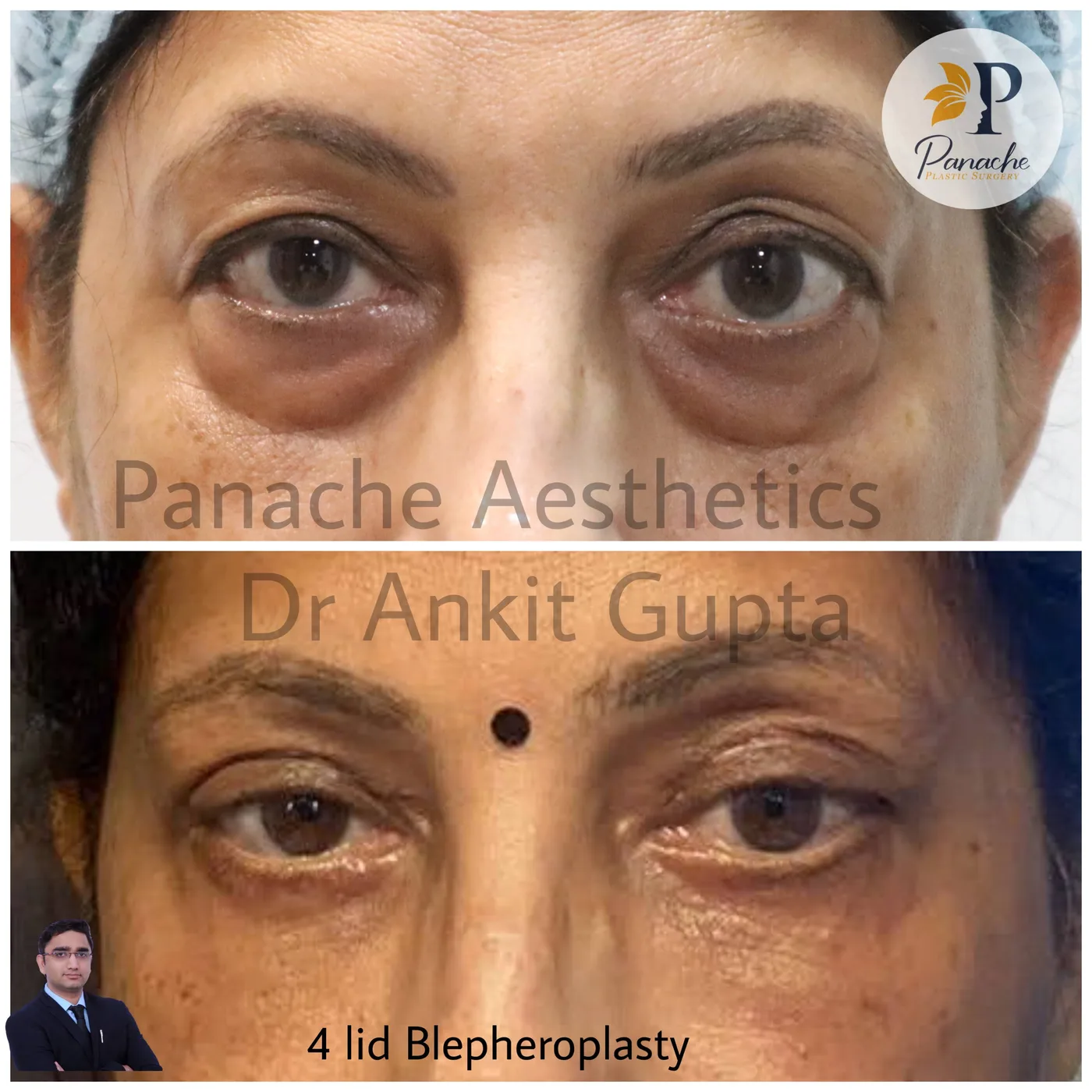 Eyelid surgery before and after — healed result — Dr. Ankit Gupta, Panache Aesthetics Delhi